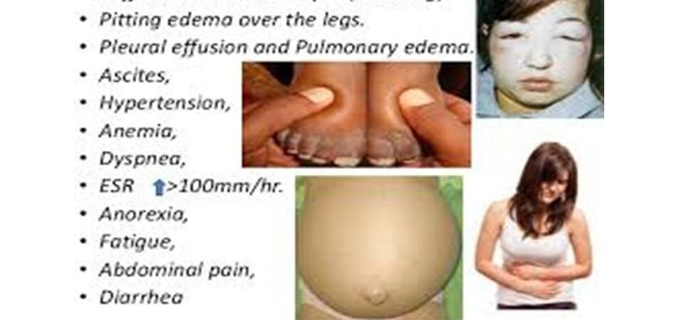 Nephrotic Syndrome Signs and Symptoms Management Nursing Care